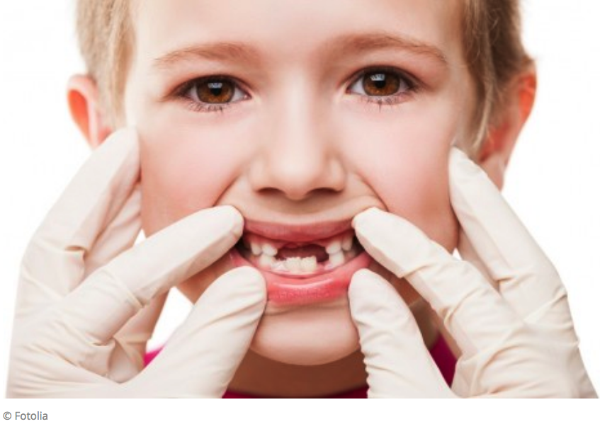 Early exposure to bisphenol A might damage the enamel of teeth.